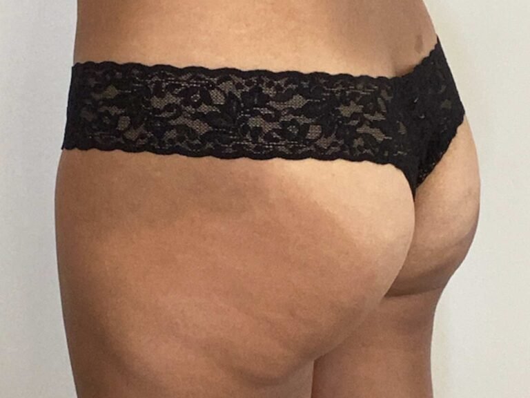 Cutera-Product-truFlex-B-A-1-768×576 Cutera-Product-truFlex-B-A-1-768x576