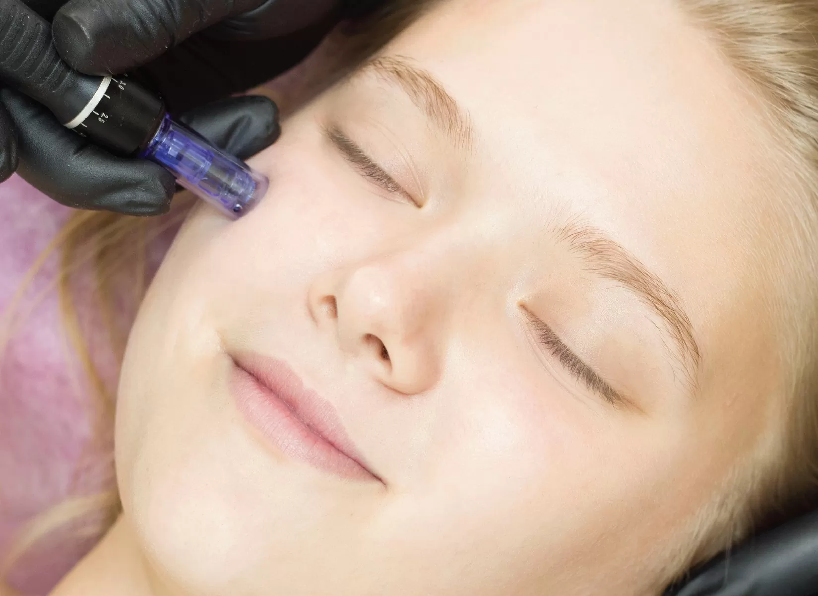 Woman getting micro needling
