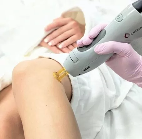 Laser hair removal treatment on legs