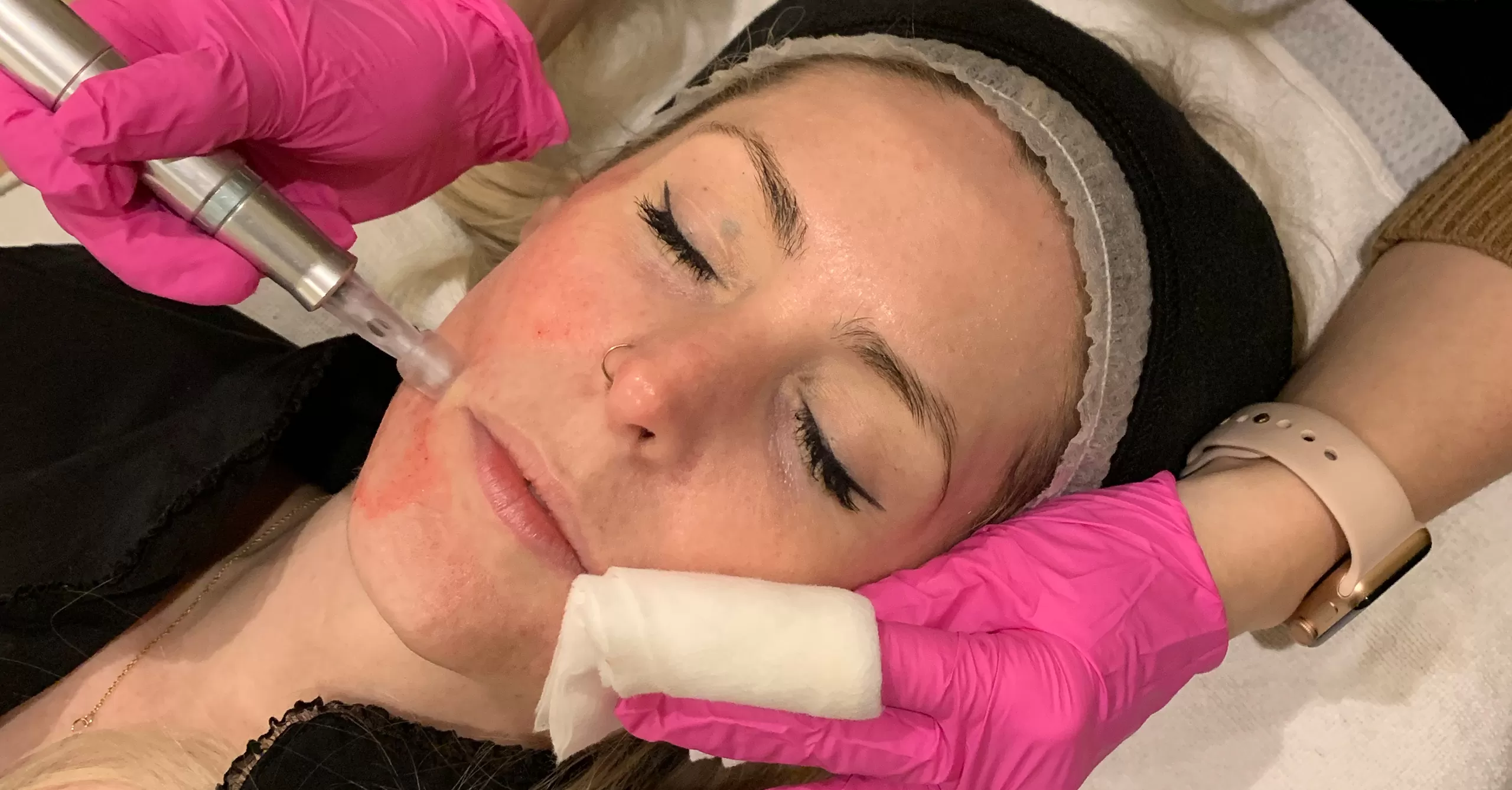 Microneedling in Edmonton