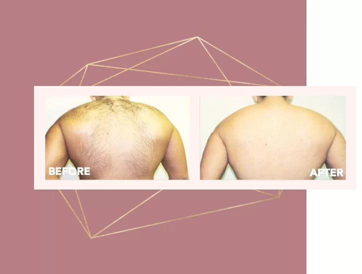 Laser hair removal is a medical procedure that uses a concentrated beam of light (laser) to remove unwanted hair