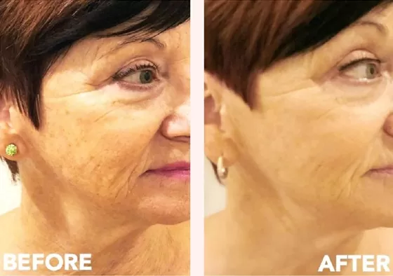 Before and after micro-needling