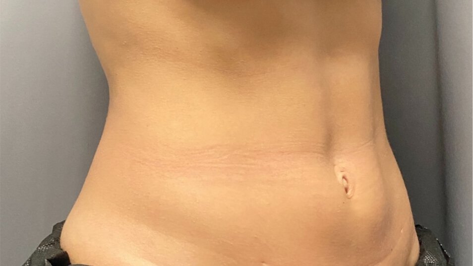 truBody_carousel_4_after